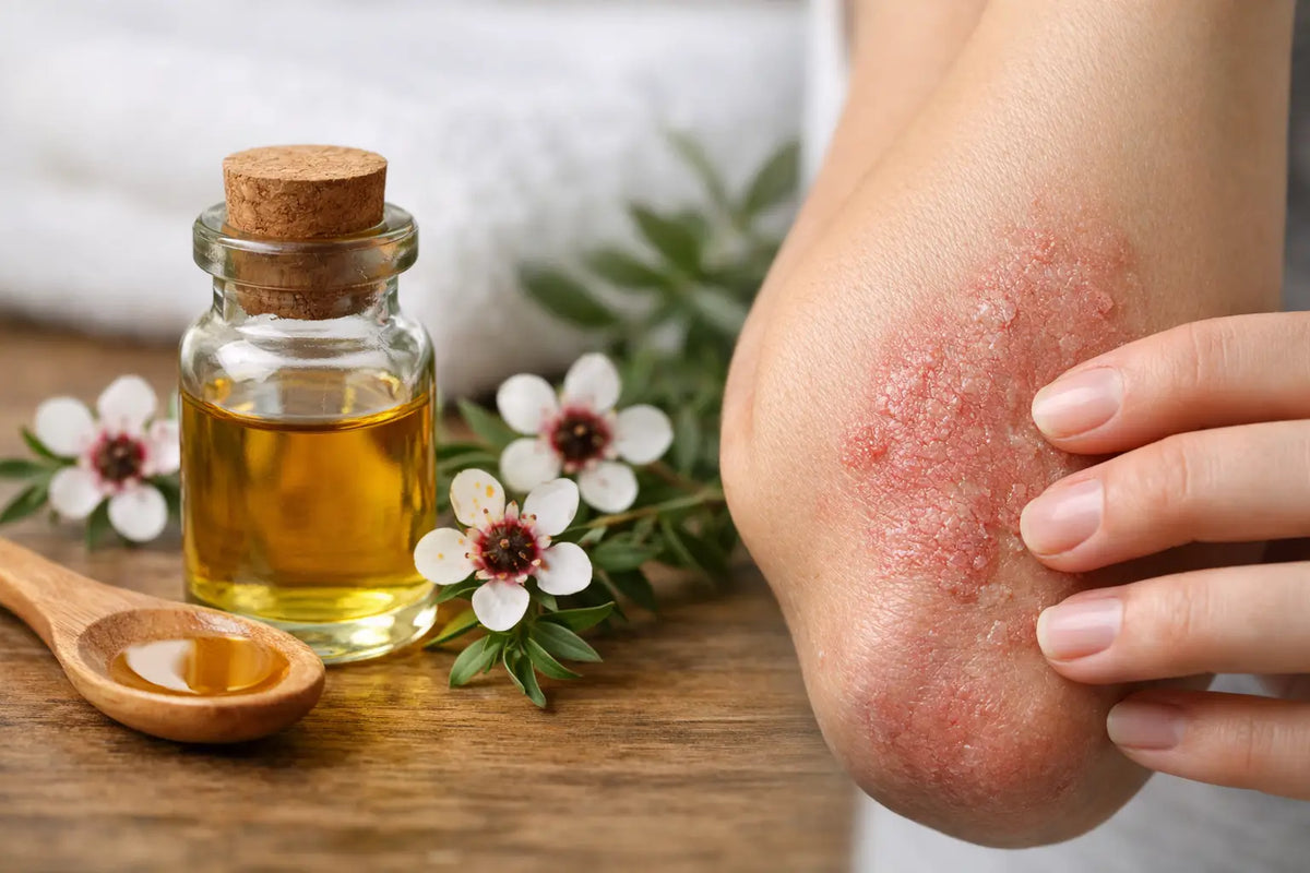 Manuka Oil for Eczema: Does It Help?