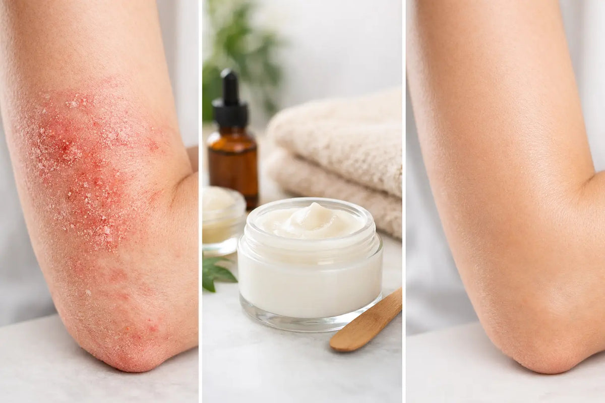 Eczema Balm Before After: What Results Mean